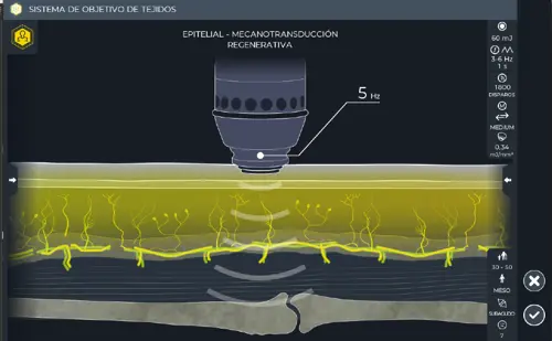 shockwave pulse 7 01477